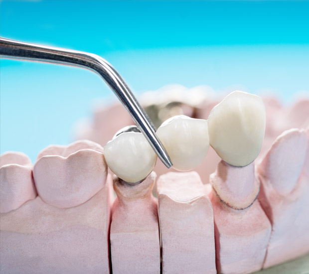 Marietta Dental Bridges
