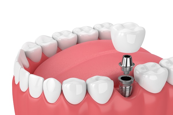 Dental Implants Marietta, GA