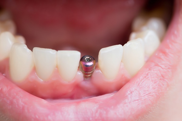 Implant Dentist Marietta, GA
